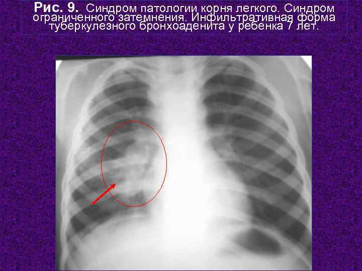 Рис. 9. Синдром патологии корня легкого. Синдром ограниченного затемнения. Инфильтративная форма  туберкулезного бронхоаденита