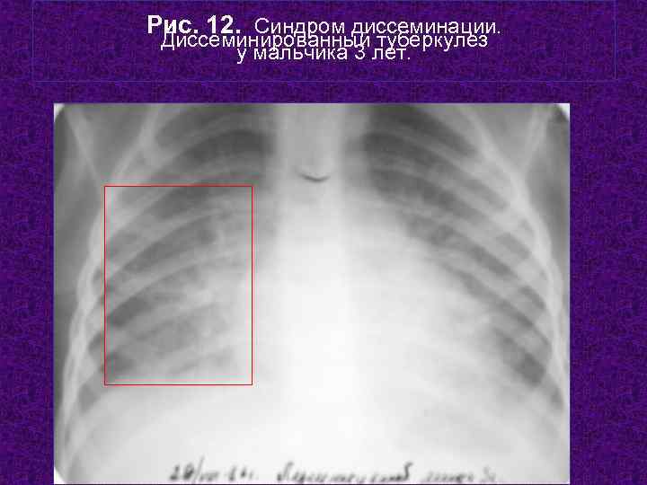 Рис. 12. Синдром диссеминации.  Диссеминированный туберкулез  у мальчика 3 лет.  