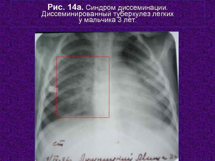  Рис. 14 а. Синдром диссеминации. Диссеминированный туберкулез легких   у мальчика 3