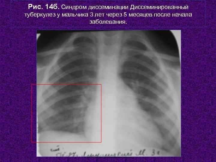  Рис. 14 б. Синдром диссеминации Диссеминированный туберкулез у мальчика 3 лет через 5