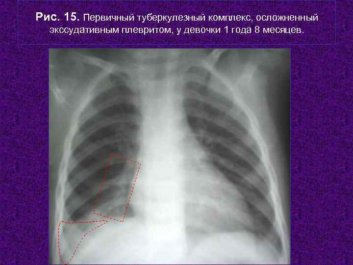 Рис. 15. Первичный туберкулезный комплекс, осложненный  экссудативным плевритом, у девочки 1 года 8