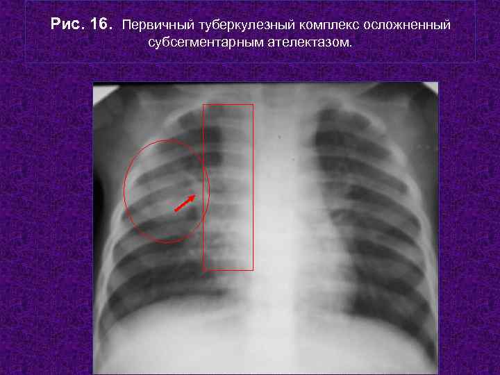 Рис. 16. Первичный туберкулезный комплекс осложненный   субсегментарным ателектазом.    