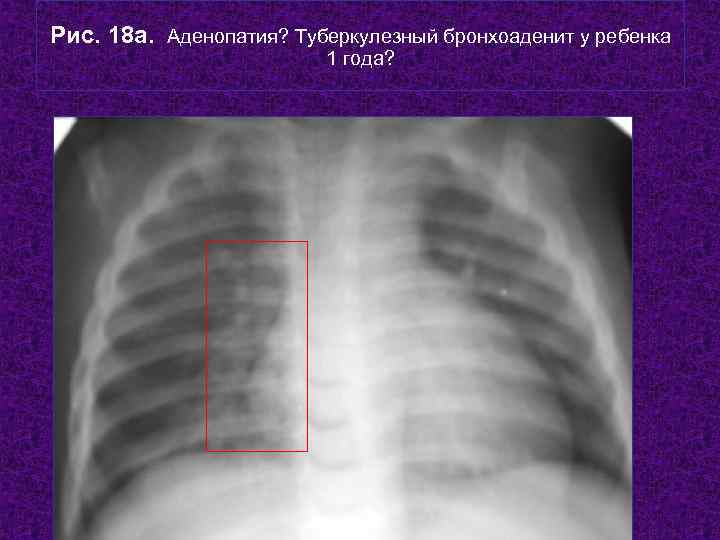 Рис. 18 а. Аденопатия? Туберкулезный бронхоаденит у ребенка     1 года?