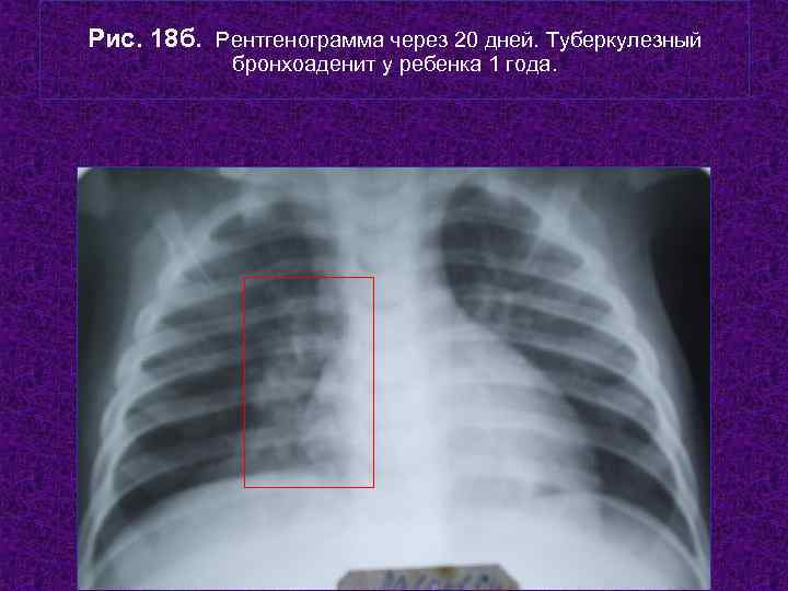 Рис. 18 б. Рентгенограмма через 20 дней. Туберкулезный   бронхоаденит у ребенка 1