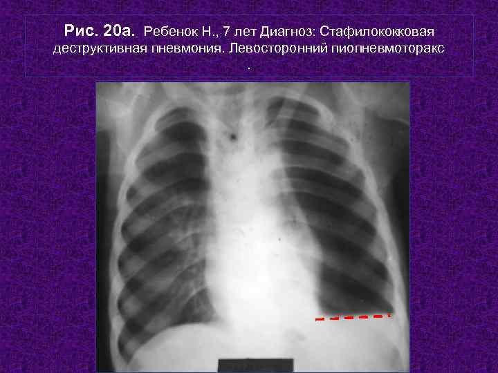  Рис. 20 а. Ребенок Н. , 7 лет Диагноз: Стафилококковая деструктивная пневмония. Левосторонний
