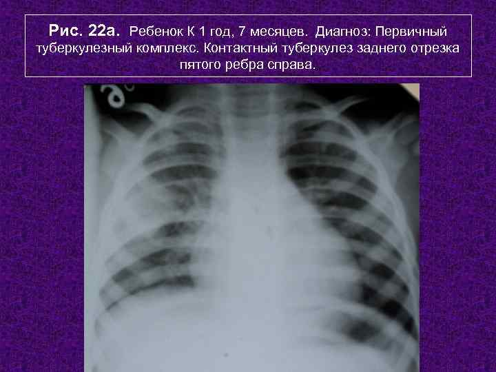 Рис. 22 а. Ребенок К 1 год, 7 месяцев. Диагноз: Первичный туберкулезный комплекс.