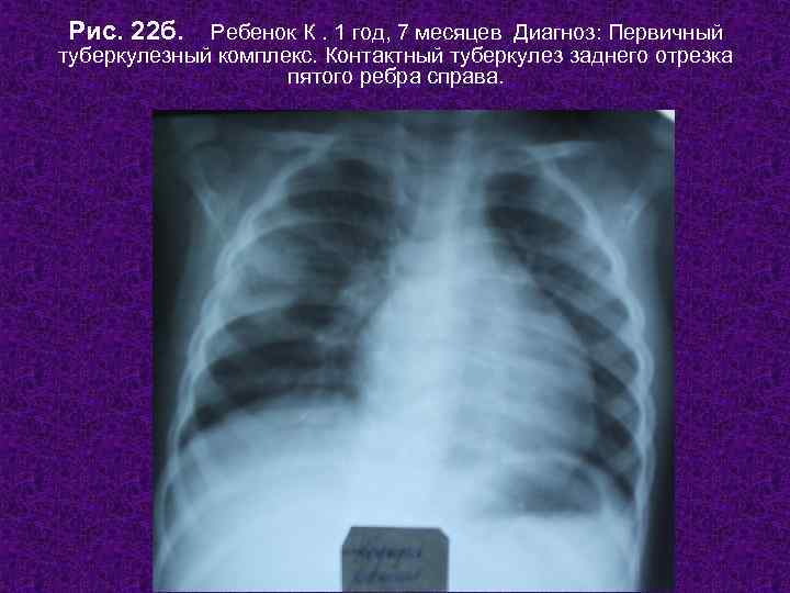 Рис. 22 б. Ребенок К. 1 год, 7 месяцев Диагноз: Первичный туберкулезный комплекс. Контактный
