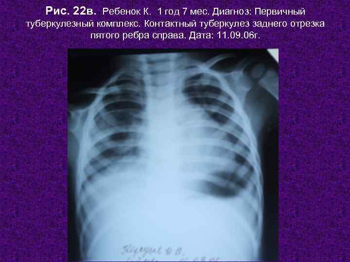   Рис. 22 в. Ребенок К. 1 год 7 мес. Диагноз: Первичный туберкулезный