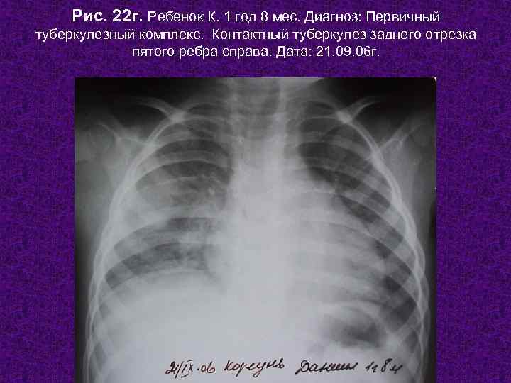   Рис. 22 г. Ребенок К. 1 год 8 мес. Диагноз: Первичный туберкулезный
