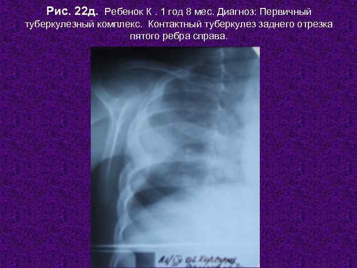   Рис. 22 д. Ребенок К. 1 год 8 мес. Диагноз: Первичный туберкулезный