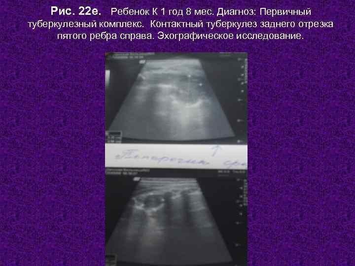   Рис. 22 е. Ребенок К 1 год 8 мес. Диагноз: Первичный туберкулезный