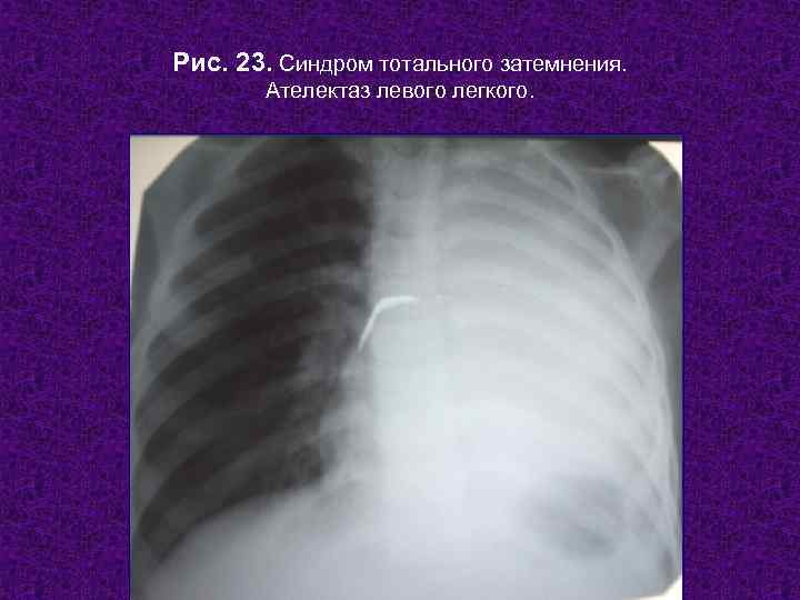 Рис. 23. Синдром тотального затемнения.   Ателектаз левого легкого.    Н.