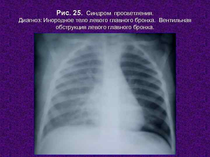   Рис. 25. Синдром просветления. Диагноз: Инородное тело левого главного бронха. Вентильная 