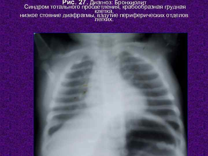    Рис. 27. Диагноз: Бронхиолит Синдром тотального просветления, крабообразная грудная  
