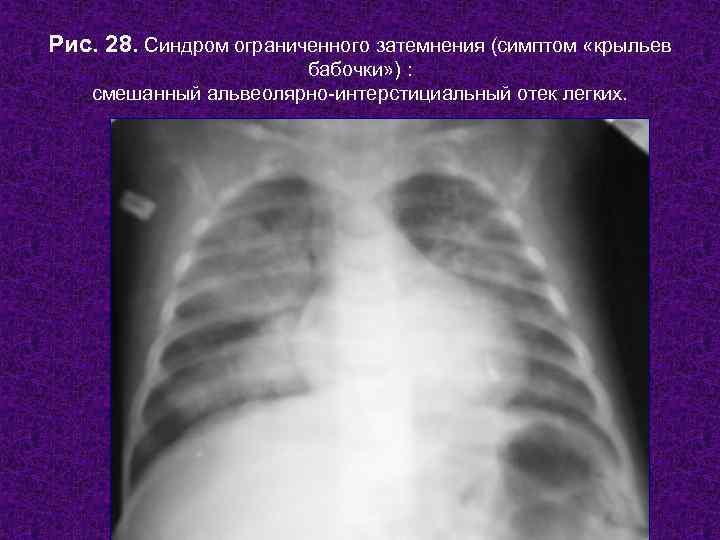 Рис. 28. Синдром ограниченного затемнения (симптом «крыльев    бабочки» ) : смешанный