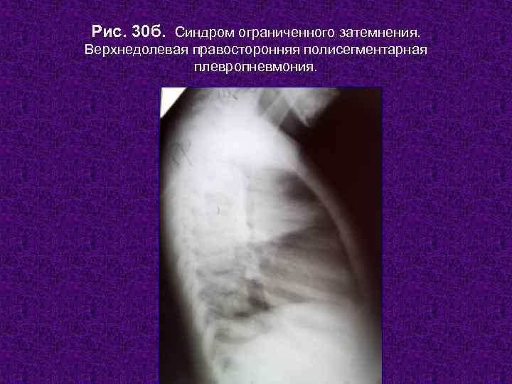 Рис. 30 б. Синдром ограниченного затемнения. Верхнедолевая правосторонняя полисегментарная    плевропневмония. 