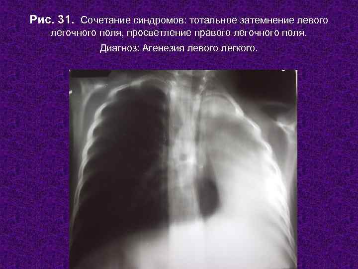 Рис. 31. Сочетание синдромов: тотальное затемнение левого легочного поля, просветление правого легочного поля. 