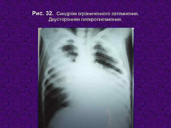Рис. 32. Синдром ограниченного затемнения.  Двусторонняя плевропневмония.   Н. С. Воротынцева, С.
