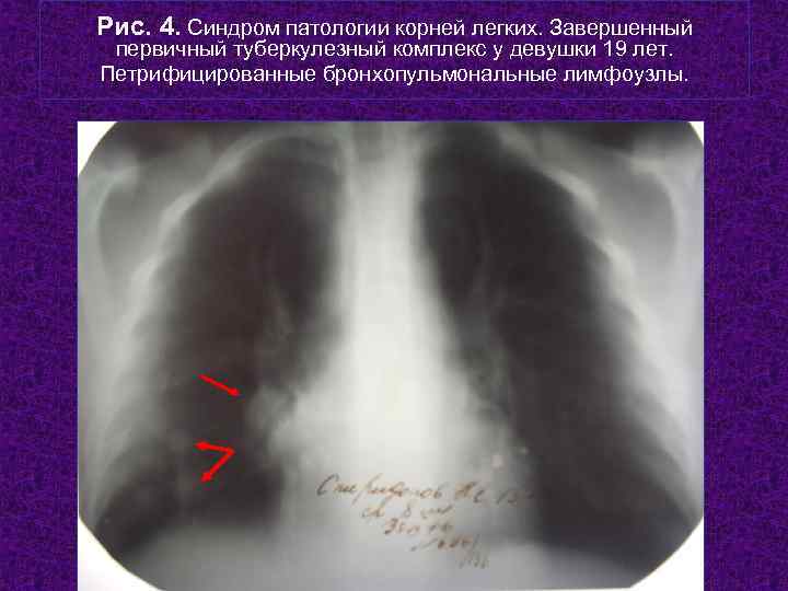 Рис. 4. Синдром патологии корней легких. Завершенный первичный туберкулезный комплекс у девушки 19 лет.