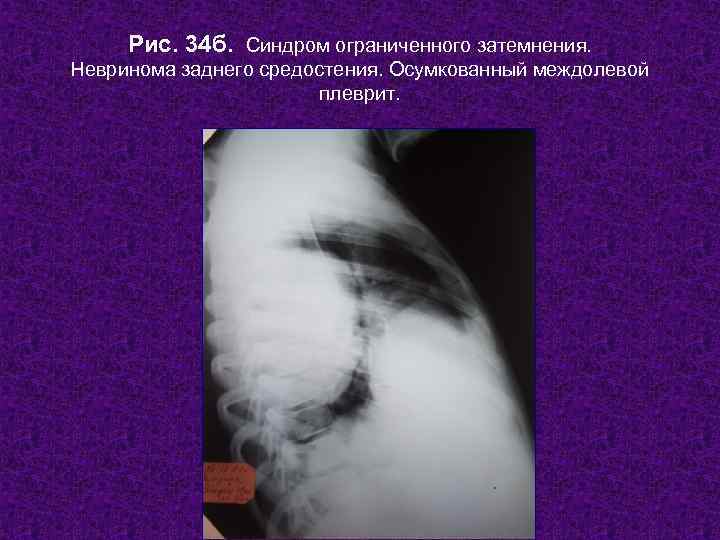  Рис. 34 б. Синдром ограниченного затемнения. Невринома заднего средостения. Осумкованный междолевой  