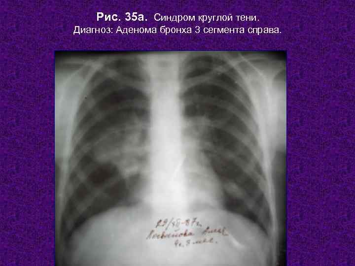   Рис. 35 а. Синдром круглой тени. Диагноз: Аденома бронха 3 сегмента справа.