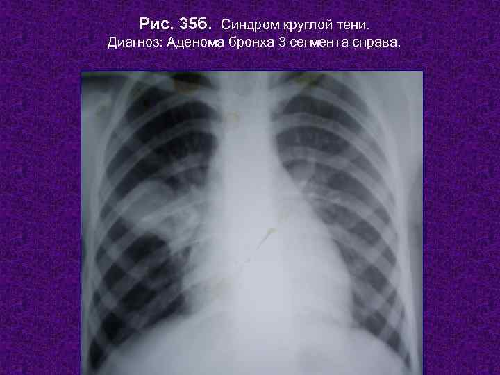   Рис. 35 б. Синдром круглой тени. Диагноз: Аденома бронха 3 сегмента справа.