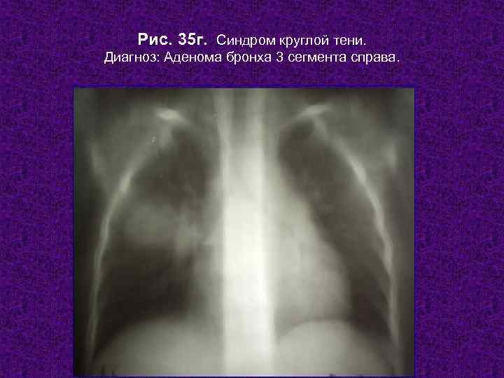  Рис. 35 г. Синдром круглой тени. Диагноз: Аденома бронха 3 сегмента справа.