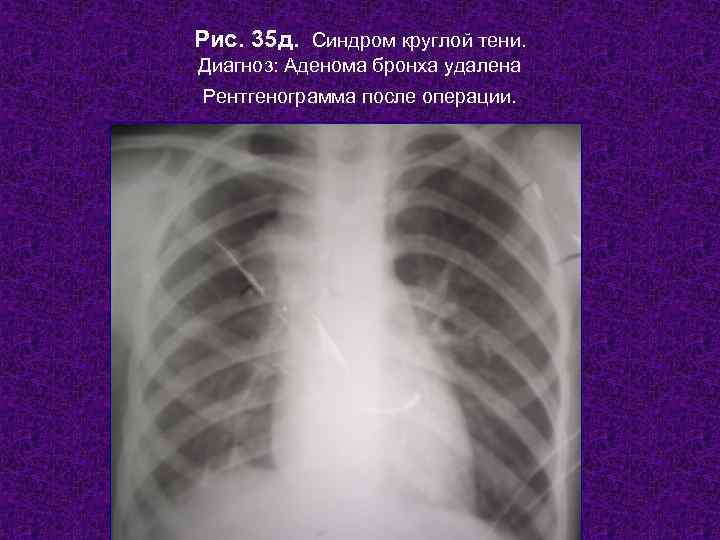 Рис. 35 д. Синдром круглой тени. Диагноз: Аденома бронха удалена Рентгенограмма после операции. 