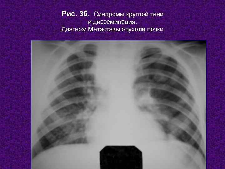 Рис. 36. Синдромы круглой тени   и диссеминация. Диагноз: Метастазы опухоли почки 