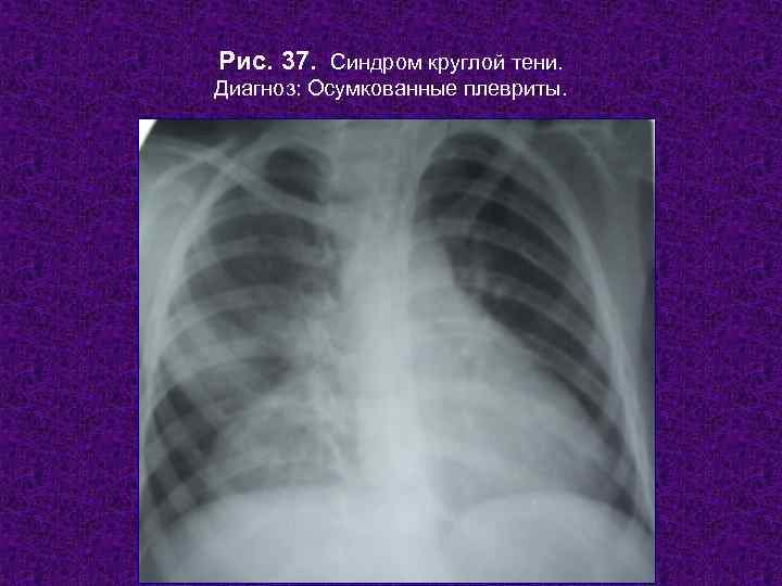 Рис. 37. Синдром круглой тени. Диагноз: Осумкованные плевриты.  Н. С. Воротынцева, С. С.