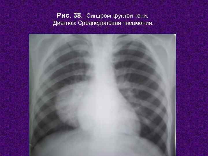  Рис. 38. Синдром круглой тени. Диагноз: Среднедолевая пневмония.  Н. С. Воротынцева, С.