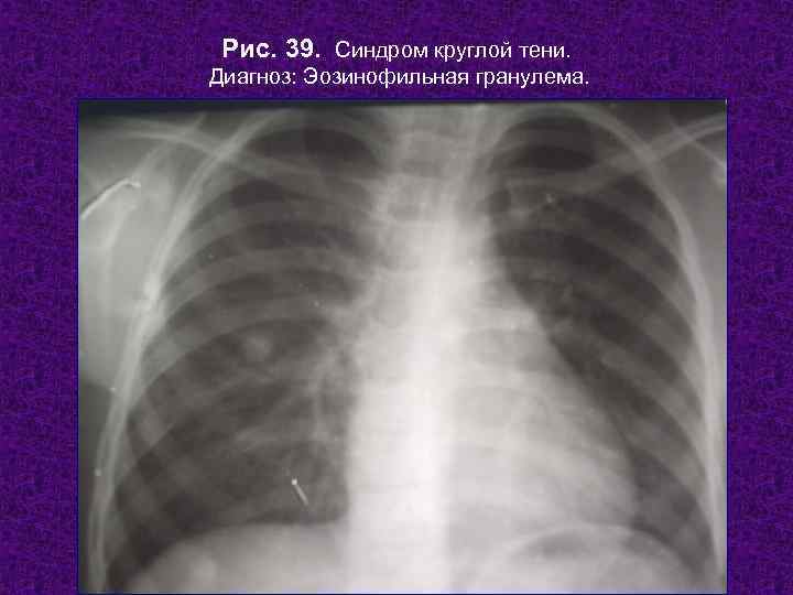  Рис. 39. Синдром круглой тени. Диагноз: Эозинофильная гранулема.  Н. С. Воротынцева, С.