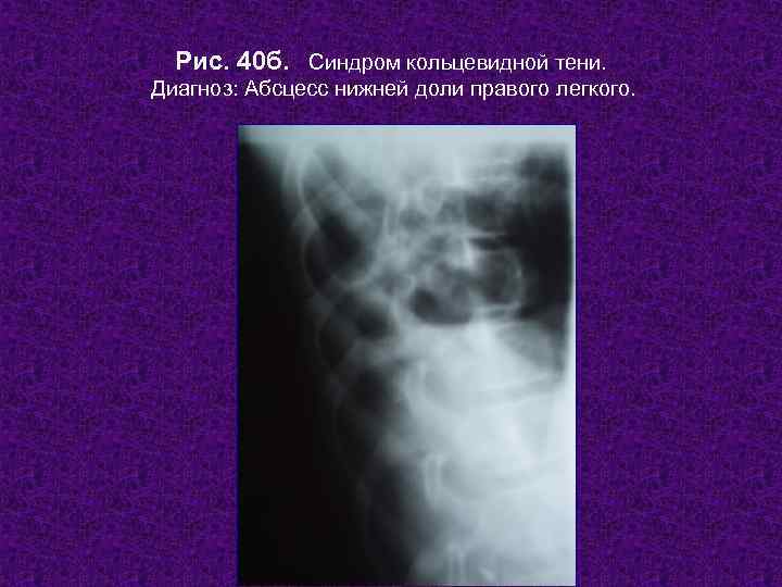  Рис. 40 б. Синдром кольцевидной тени. Диагноз: Абсцесс нижней доли правого легкого. 