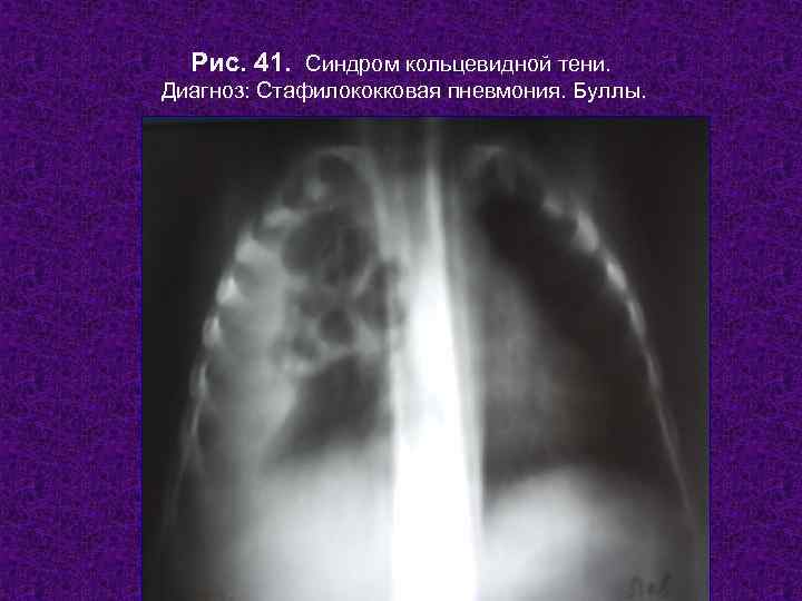 Рис. 41. Синдром кольцевидной тени. Диагноз: Стафилококковая пневмония. Буллы.    Н.