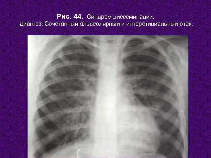   Рис. 44. Синдром диссеминации. Диагноз: Сочетанный альвеолярный и интерстициальный отек.  