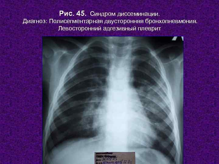   Рис. 45. Синдром диссеминации. Диагноз: Полисегментарная двусторонняя бронхопневмония.   Левосторонний адгезивный