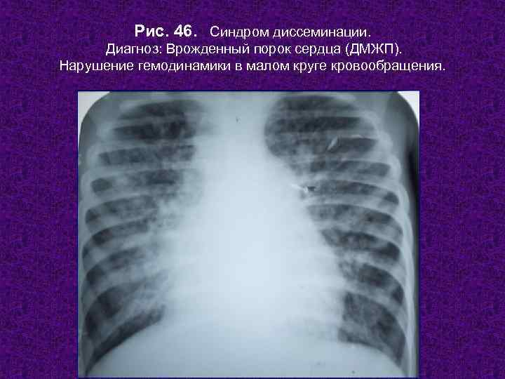    Рис. 46. Синдром диссеминации.  Диагноз: Врожденный порок сердца (ДМЖП). Нарушение