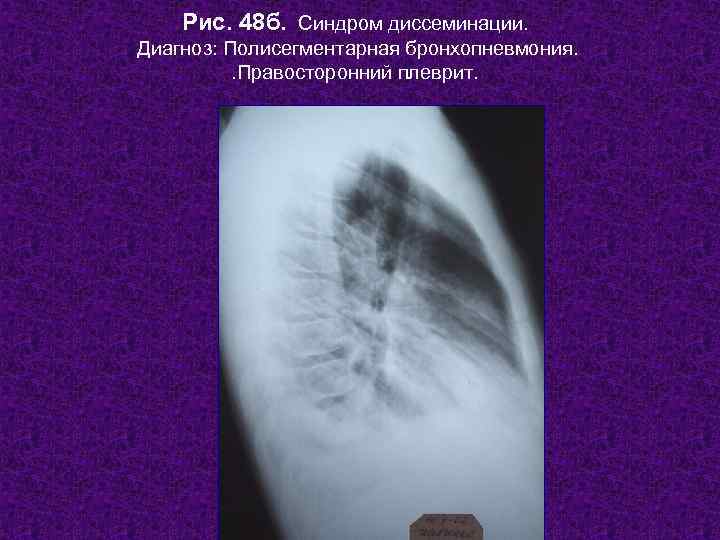   Рис. 48 б. Синдром диссеминации. Диагноз: Полисегментарная бронхопневмония.  . Правосторонний плеврит.