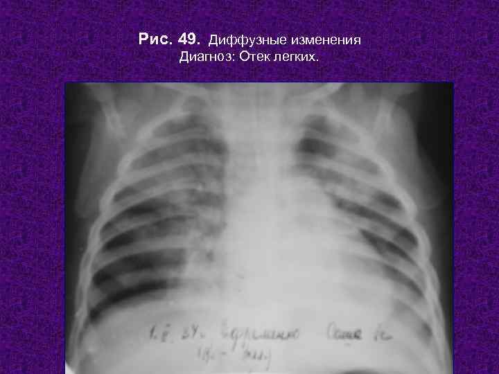 Рис. 49. Диффузные изменения Диагноз: Отек легких.   Н. С. Воротынцева, С. С.