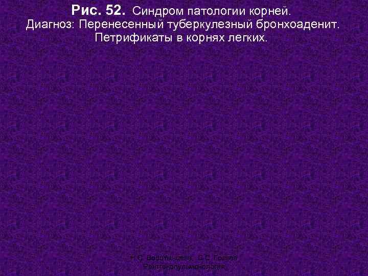   Рис. 52. Синдром патологии корней. Диагноз: Перенесенный туберкулезный бронхоаденит.   Петрификаты