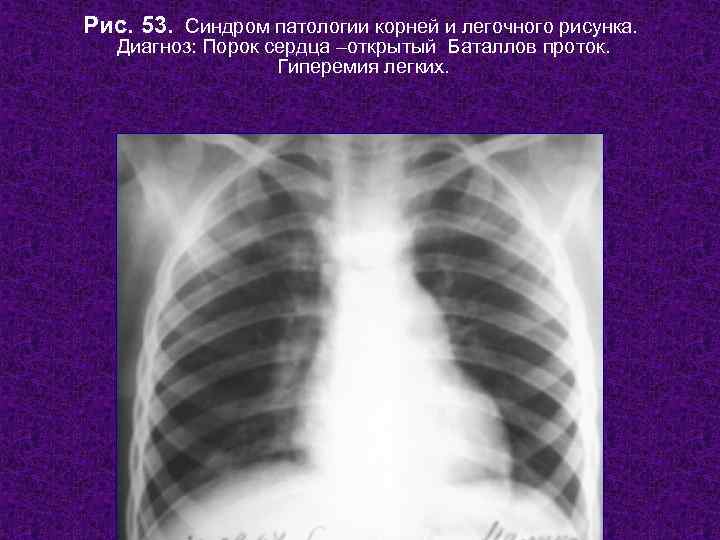 Рис. 53. Синдром патологии корней и легочного рисунка. Диагноз: Порок сердца –открытый Баталлов проток.