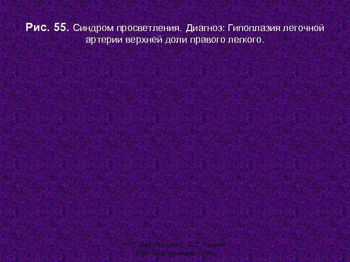 Рис. 55. Синдром просветления. Диагноз: Гипоплазия легочной  артерии верхней доли правого легкого. 