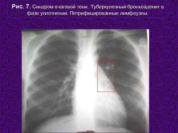 Рис. 7. Синдром очаговой тени. Туберкулезный бронхоаденит в фазе уплотнения. Петрифицированные лимфоузлы.  