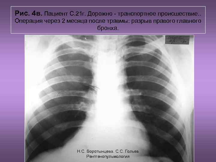 Рис. 4 в. Пациент С. 21 г. Дорожно - транспортное происшествие. . Операция через