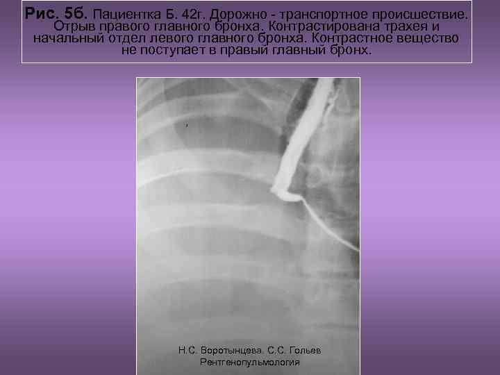 Рис. 5 б. Пациентка Б. 42 г. Дорожно - транспортное происшествие. Отрыв правого главного