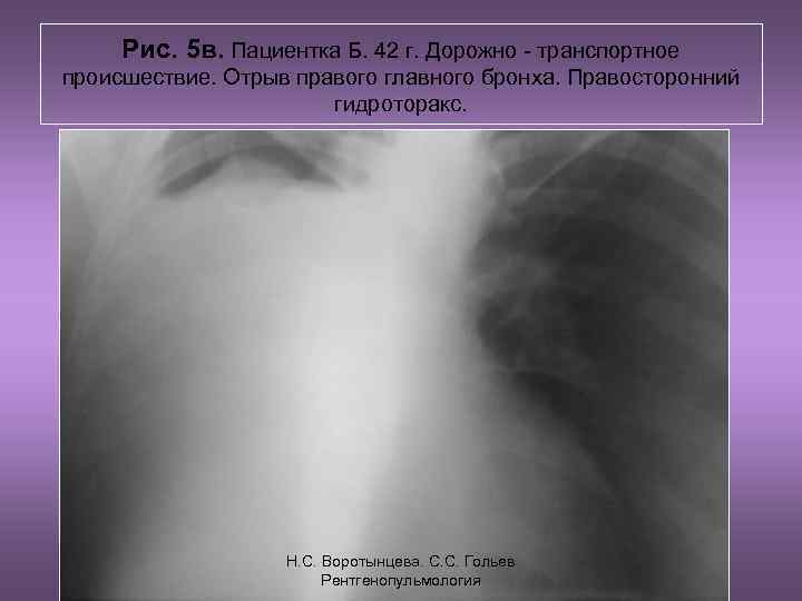 Рис. 5 в. Пациентка Б. 42 г. Дорожно - транспортное происшествие. Отрыв правого