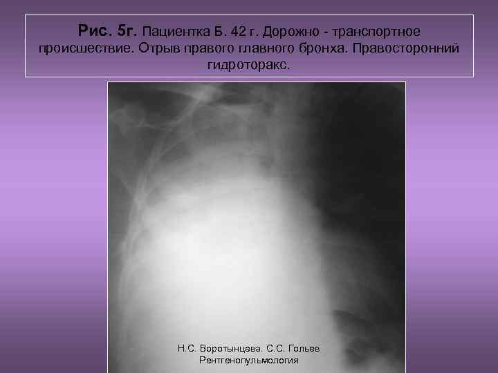  Рис. 5 г. Пациентка Б. 42 г. Дорожно - транспортное происшествие. Отрыв правого