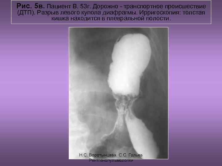Рис. 5 в. Пациент В. 53 г. Дорожно - транспортное происшествие (ДТП). Разрыв левого