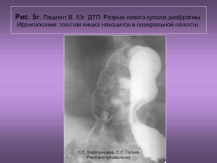 Рис. 5 г. Пациент В. 53 г. ДТП. Разрыв левого купола диафрагмы. Ирригоскопия: толстая