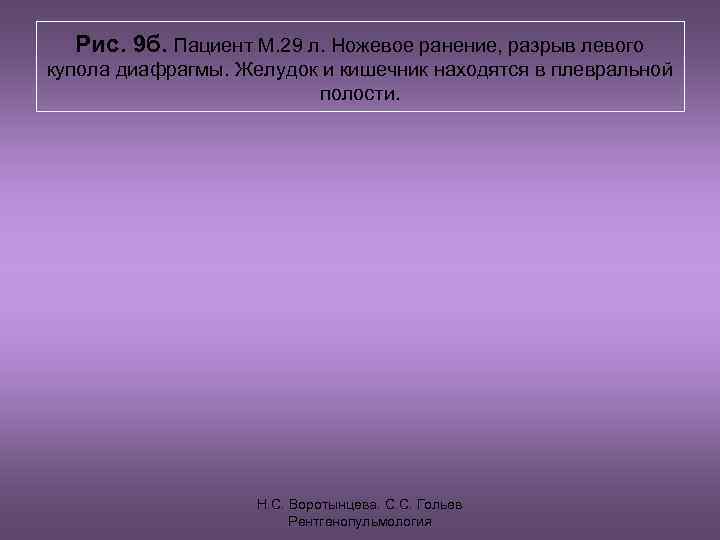 Рис. 9 б. Пациент М. 29 л. Ножевое ранение, разрыв левого купола диафрагмы.